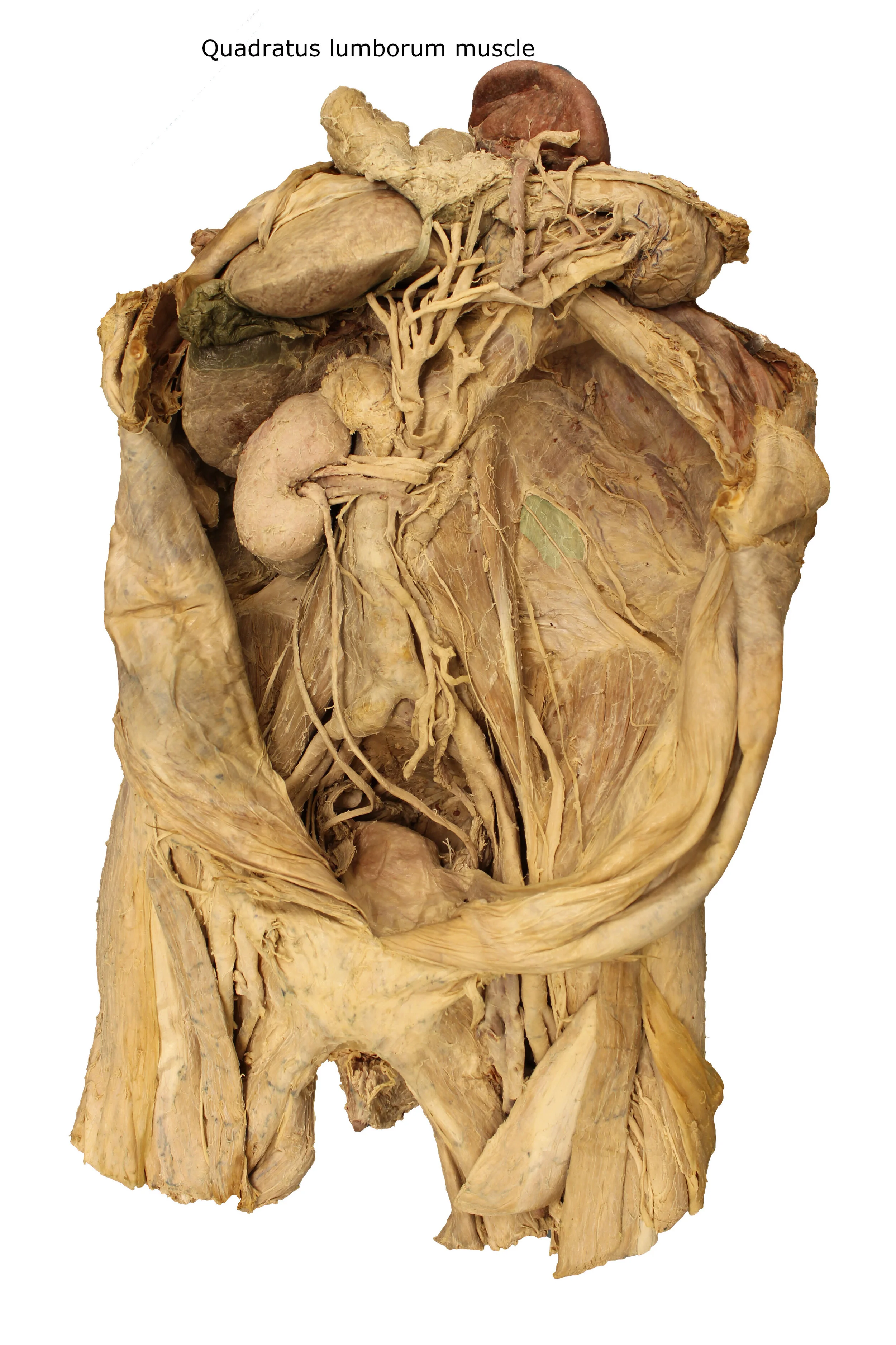 Quadratus lumborum muscle_editedimage_labelled.JPG
