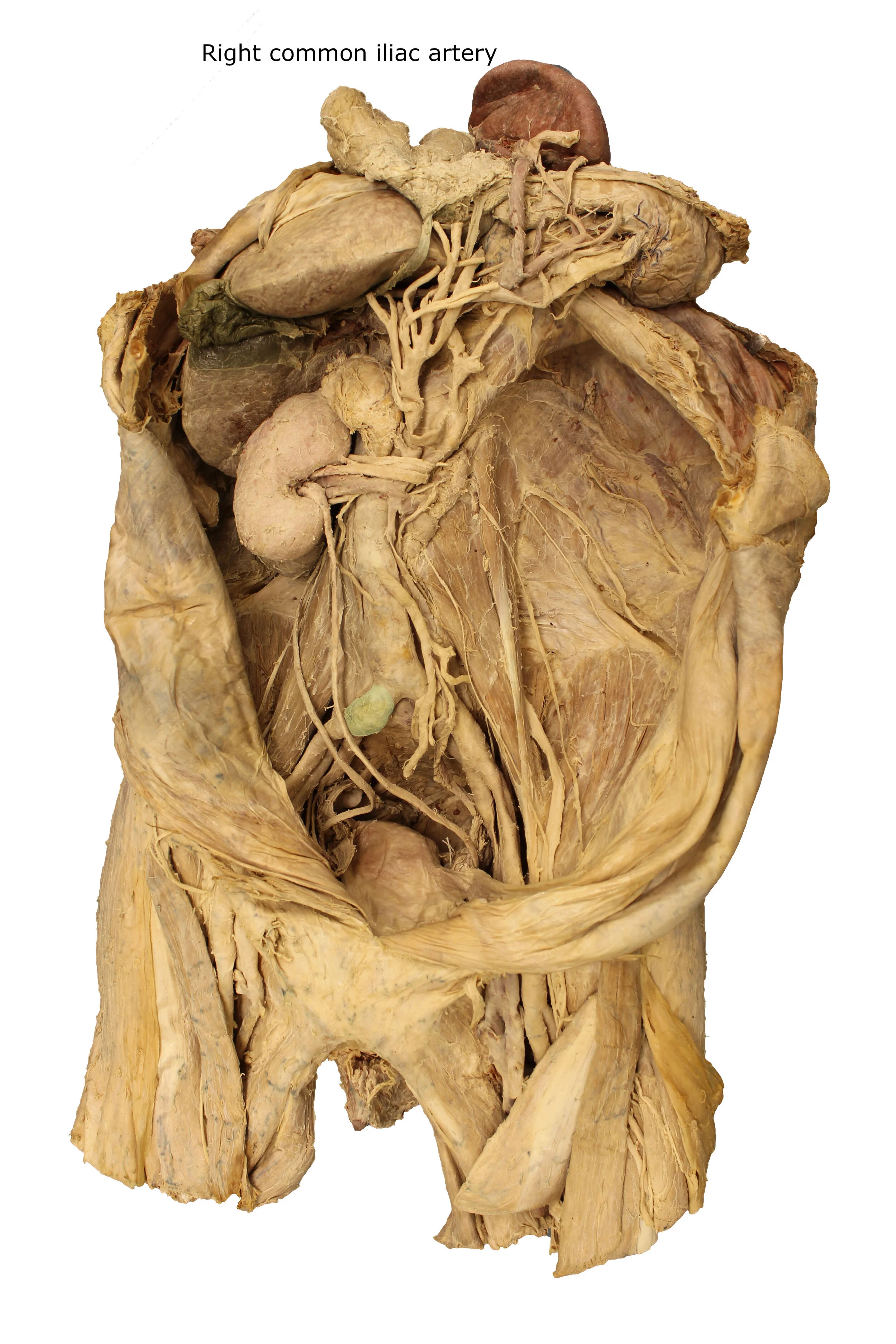 Right common iliac artery_editedimage_labelled.JPG