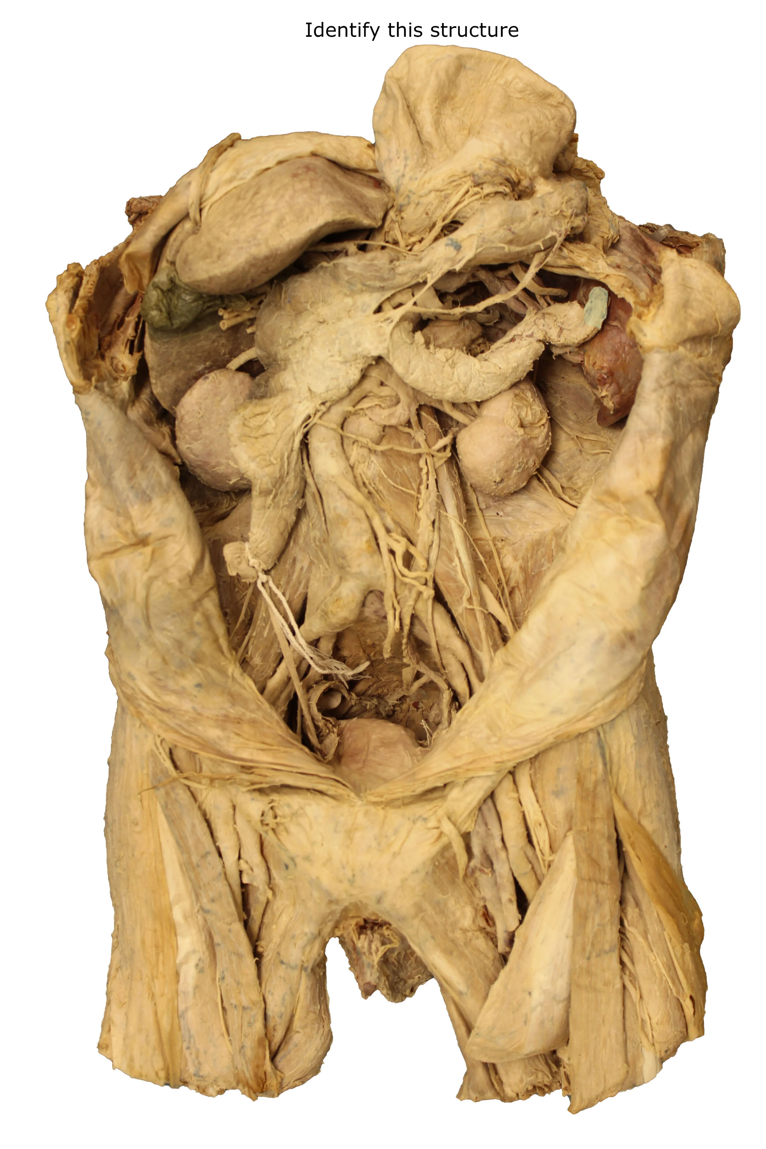 Tail of the pancreas_editedimage_identify.JPG