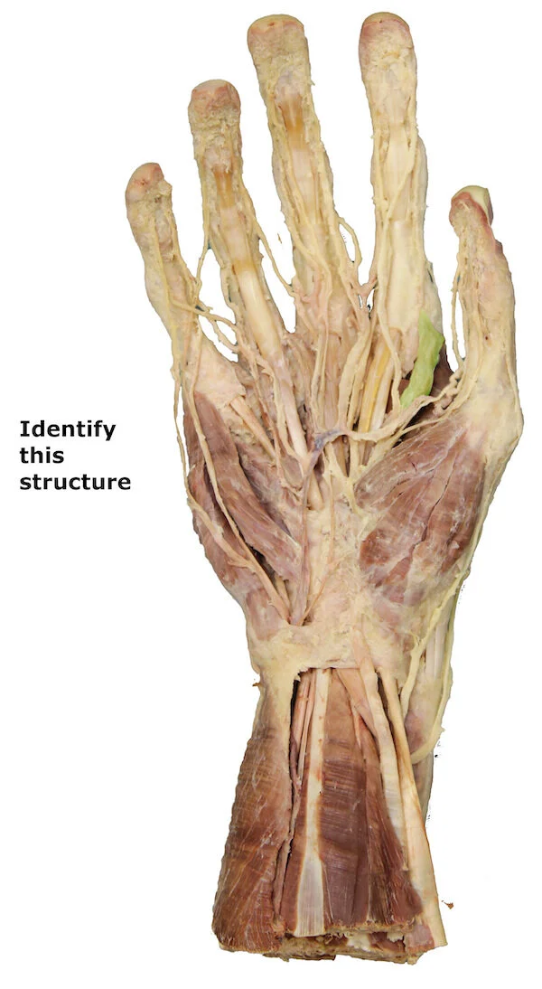 First lumbrical muscle_editedimage_identify.jpg