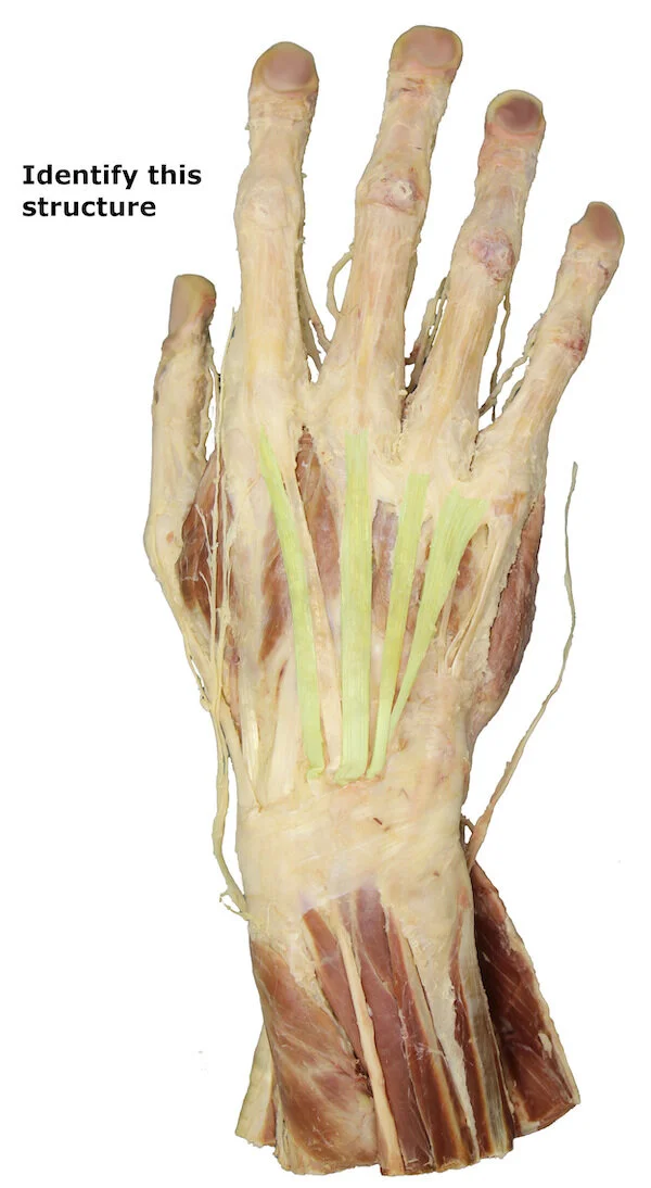Tendon of the extensor digitorum muscle_editedimage_identify.jpg