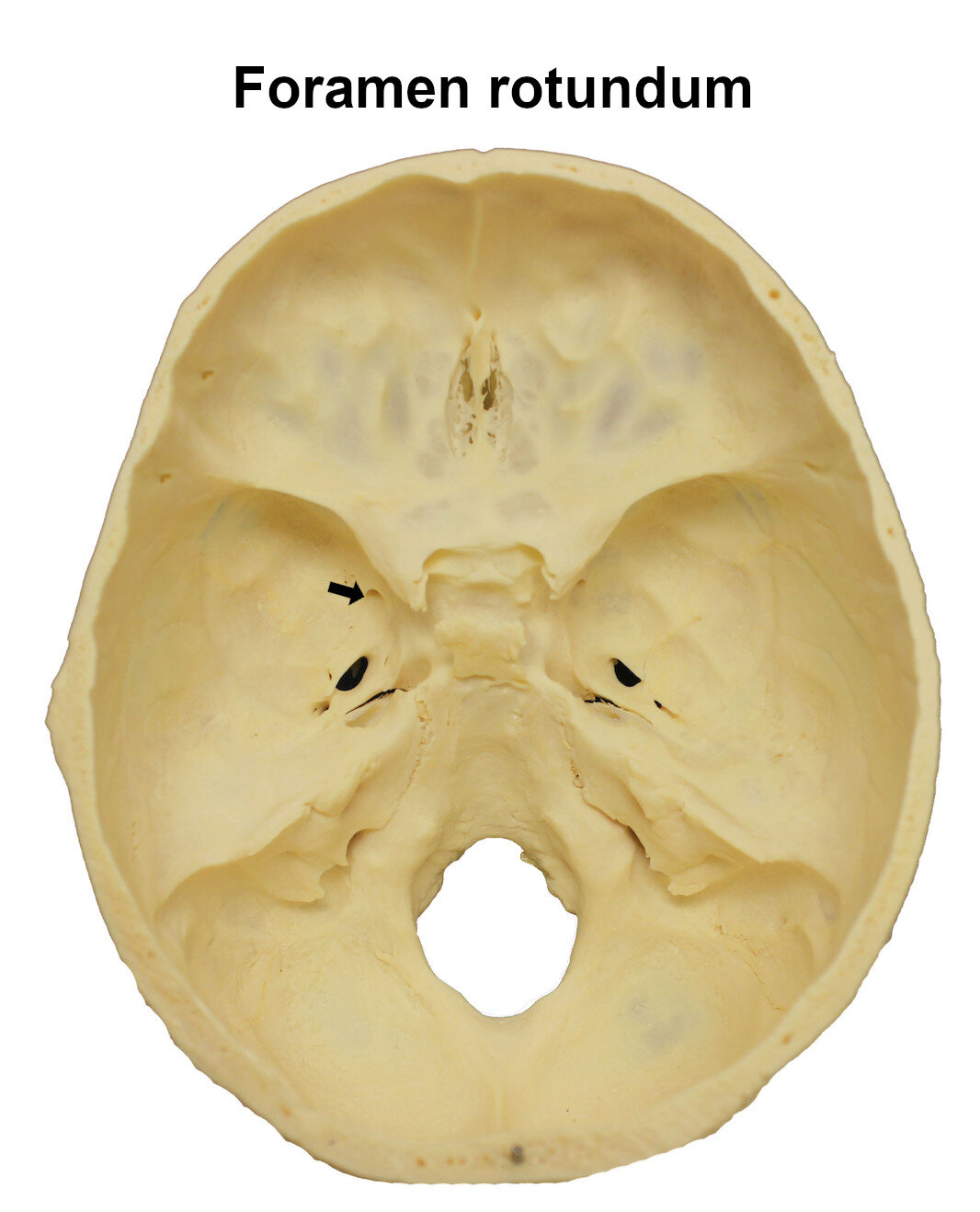 foramenrotundum_editedimage_labelled.jpg