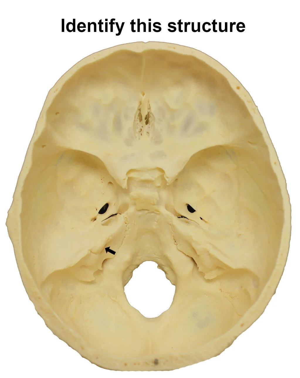 internalauditorymeatus_editedimage_identify.jpg