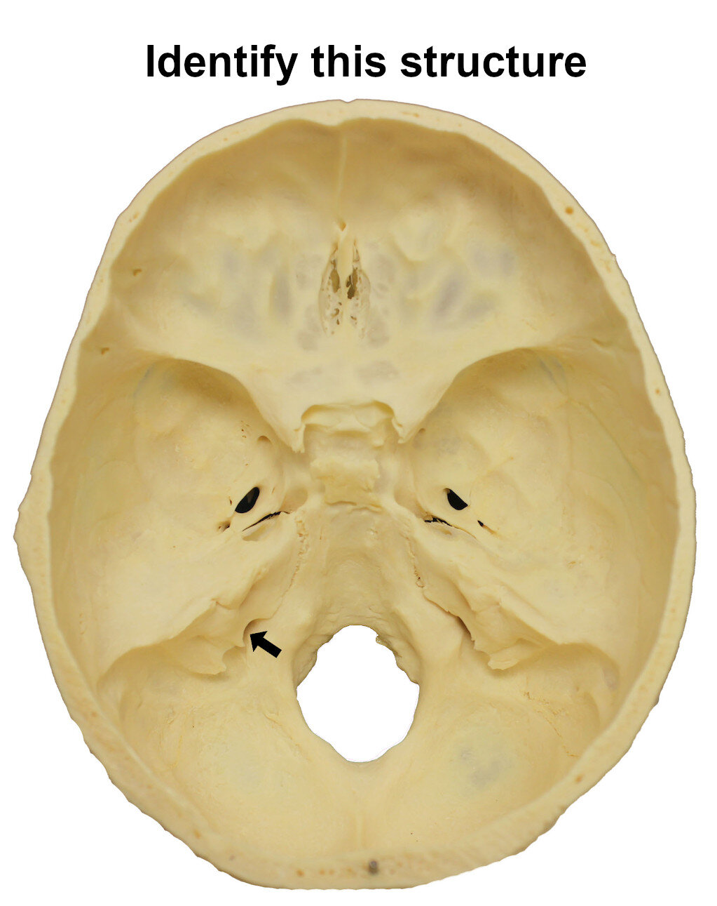 jugularforamen_editedimage_identify.jpg