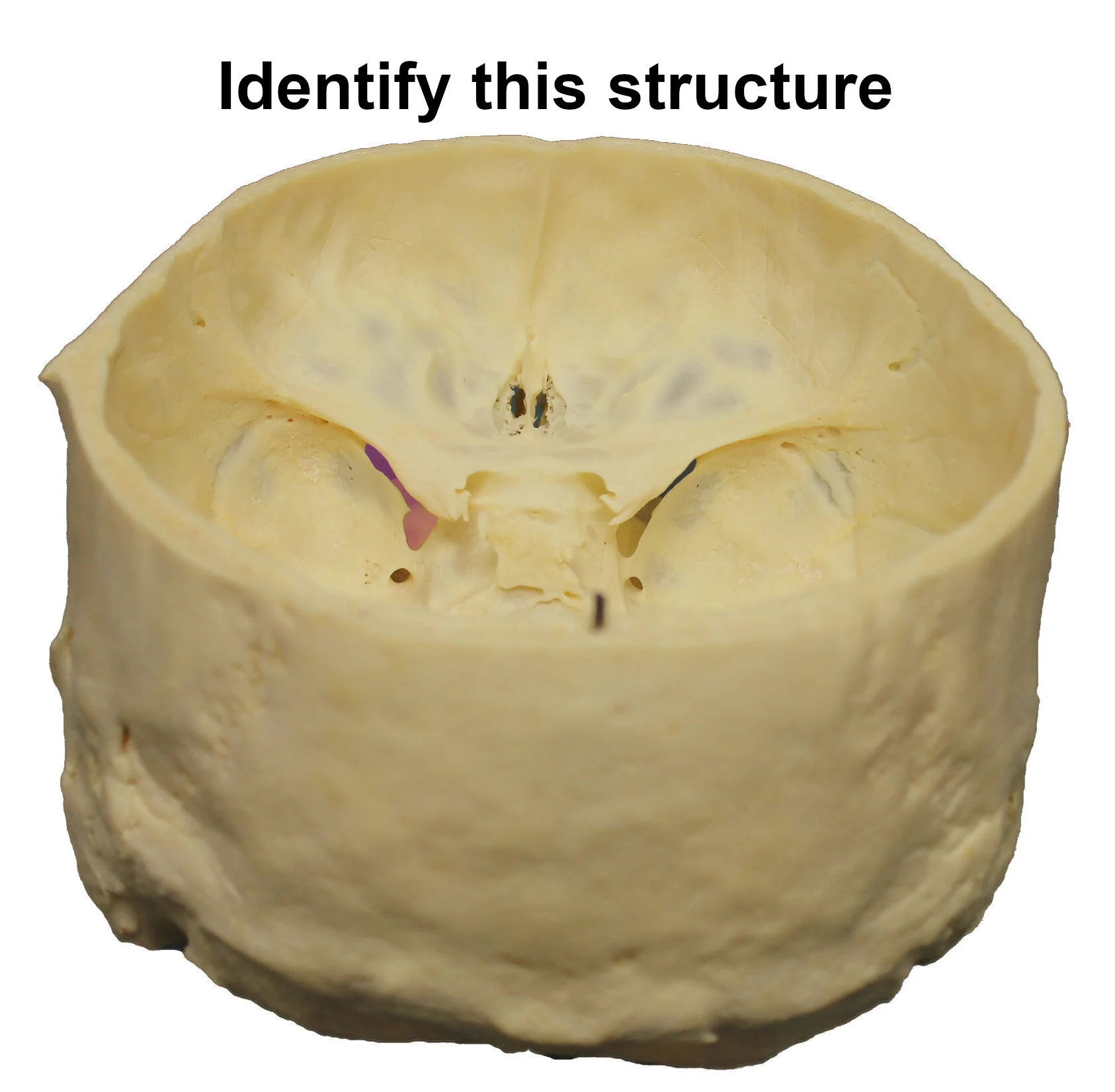superiororbitalfissure_editedimage_identify.jpg