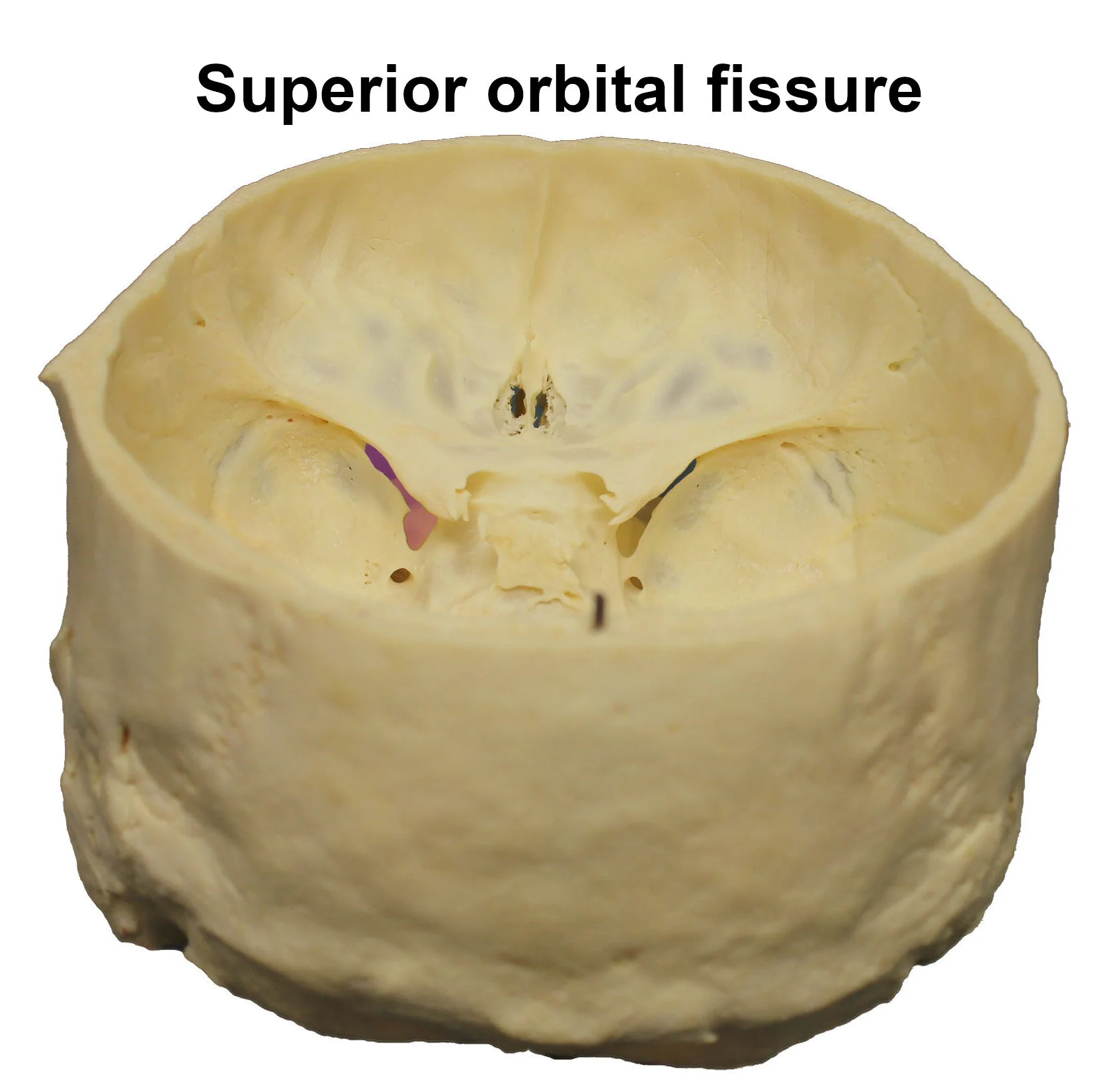 superiororbitalfissure_editedimage_labelled.jpg