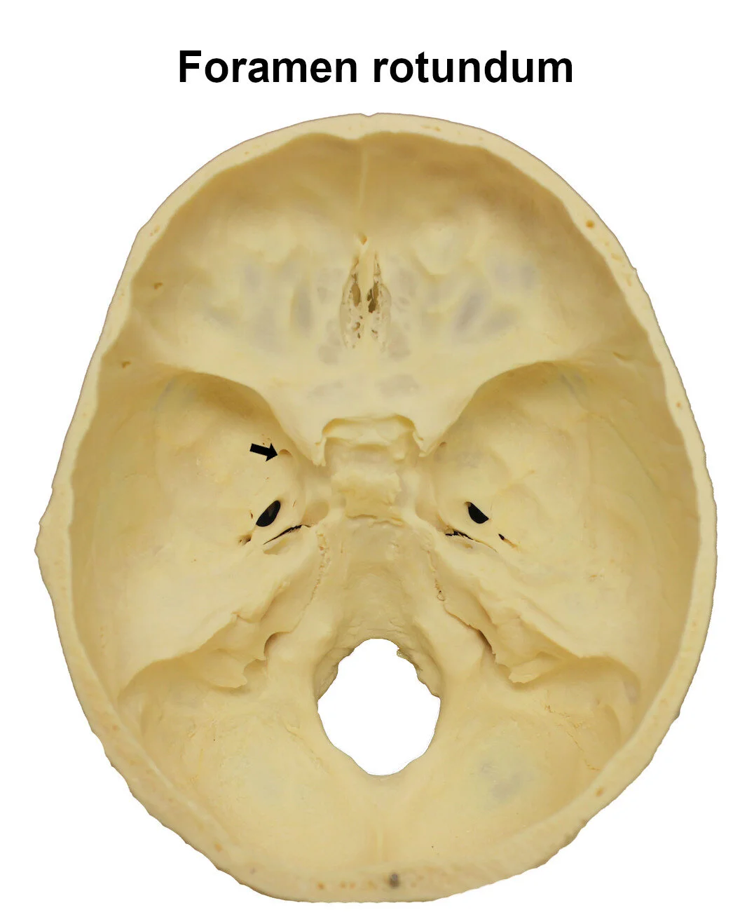 foramenrotundum_editedimage_labelled.jpg