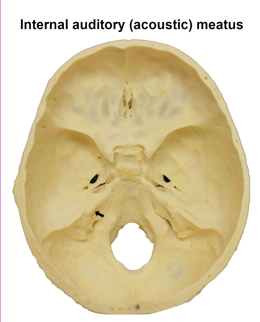 internalauditorymeatus_editedimage_labelled.jpg