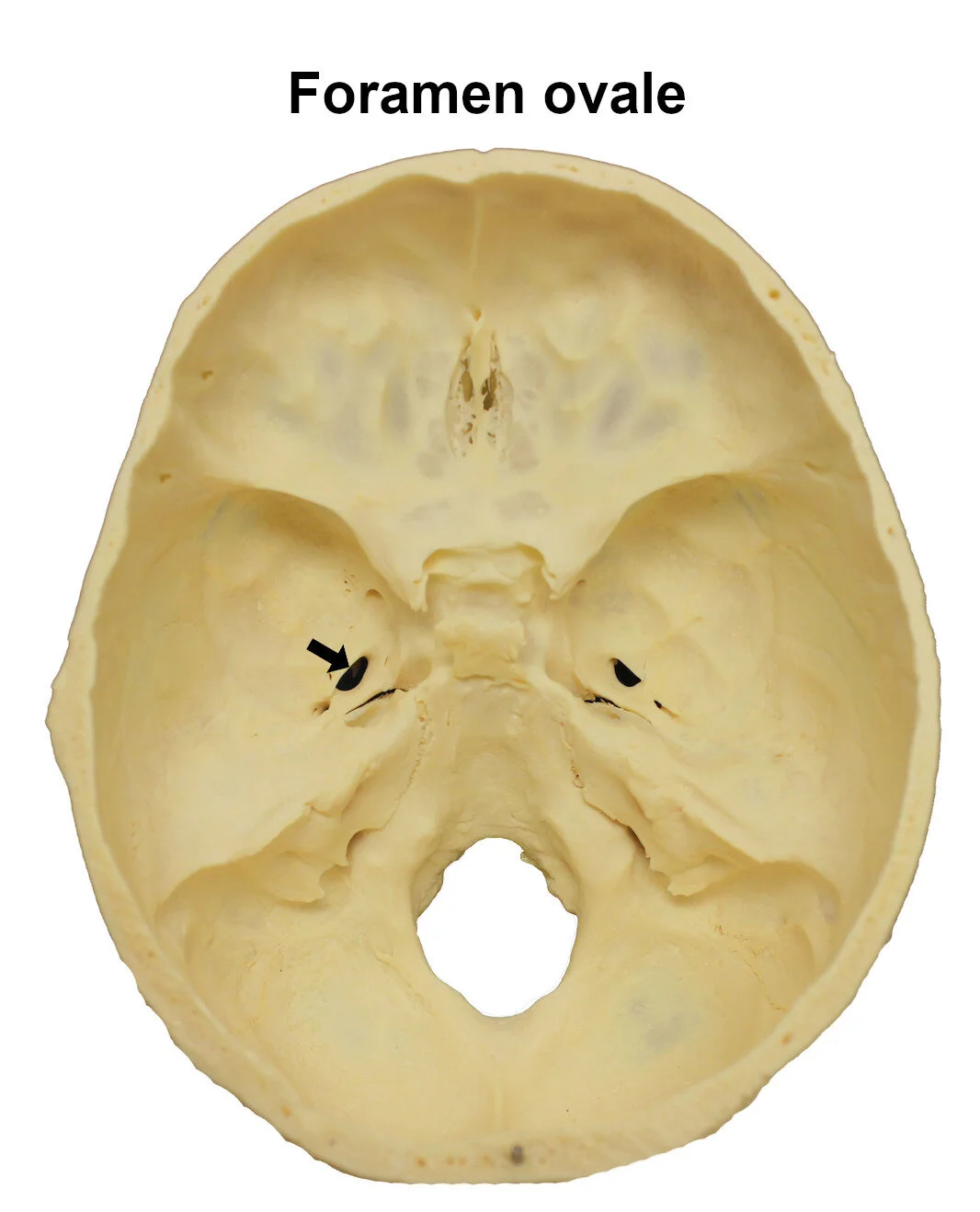 foramenovale_editedimage_labelled.jpg