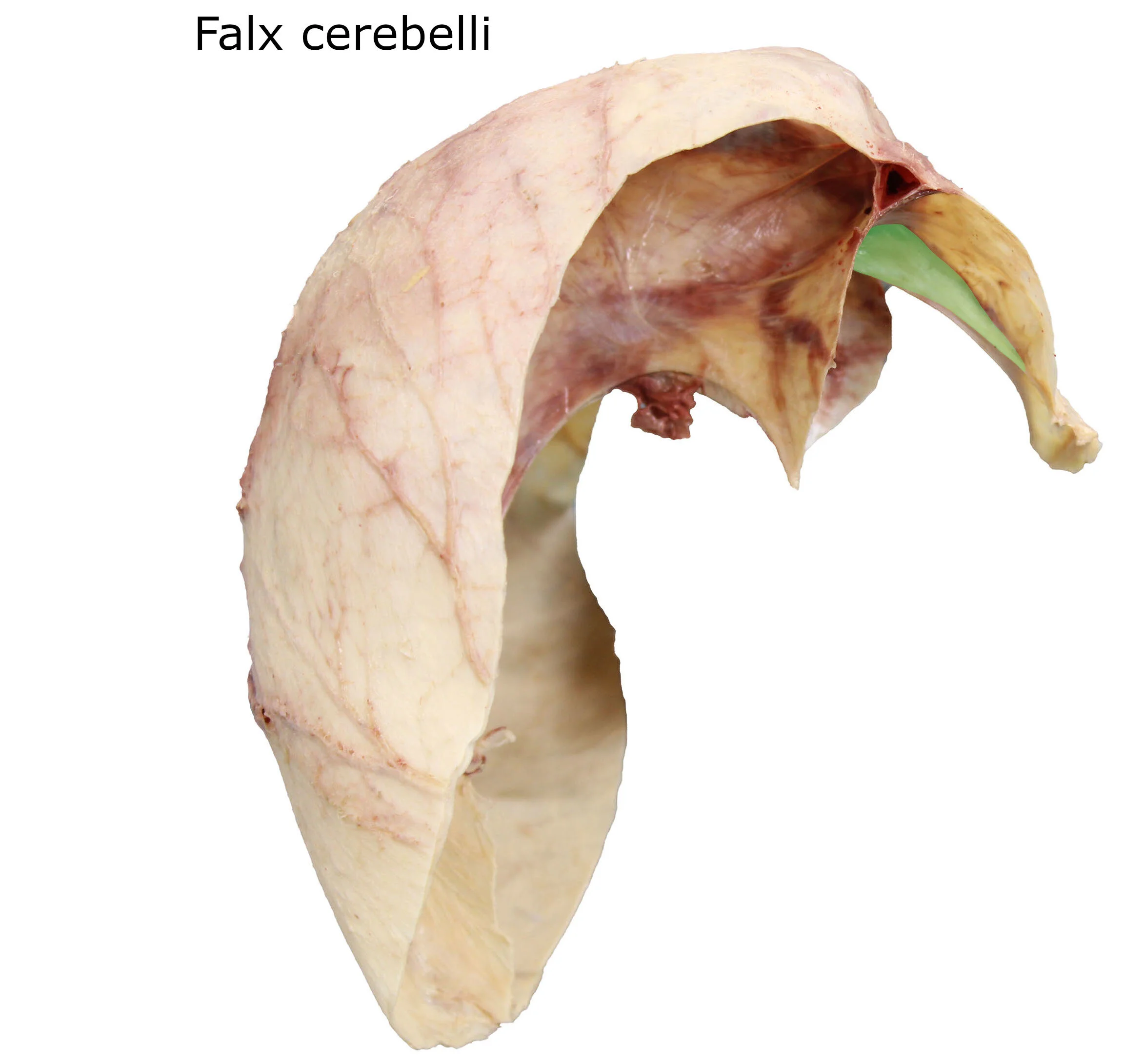Falxcerebelli_editedimage_labelled.JPG