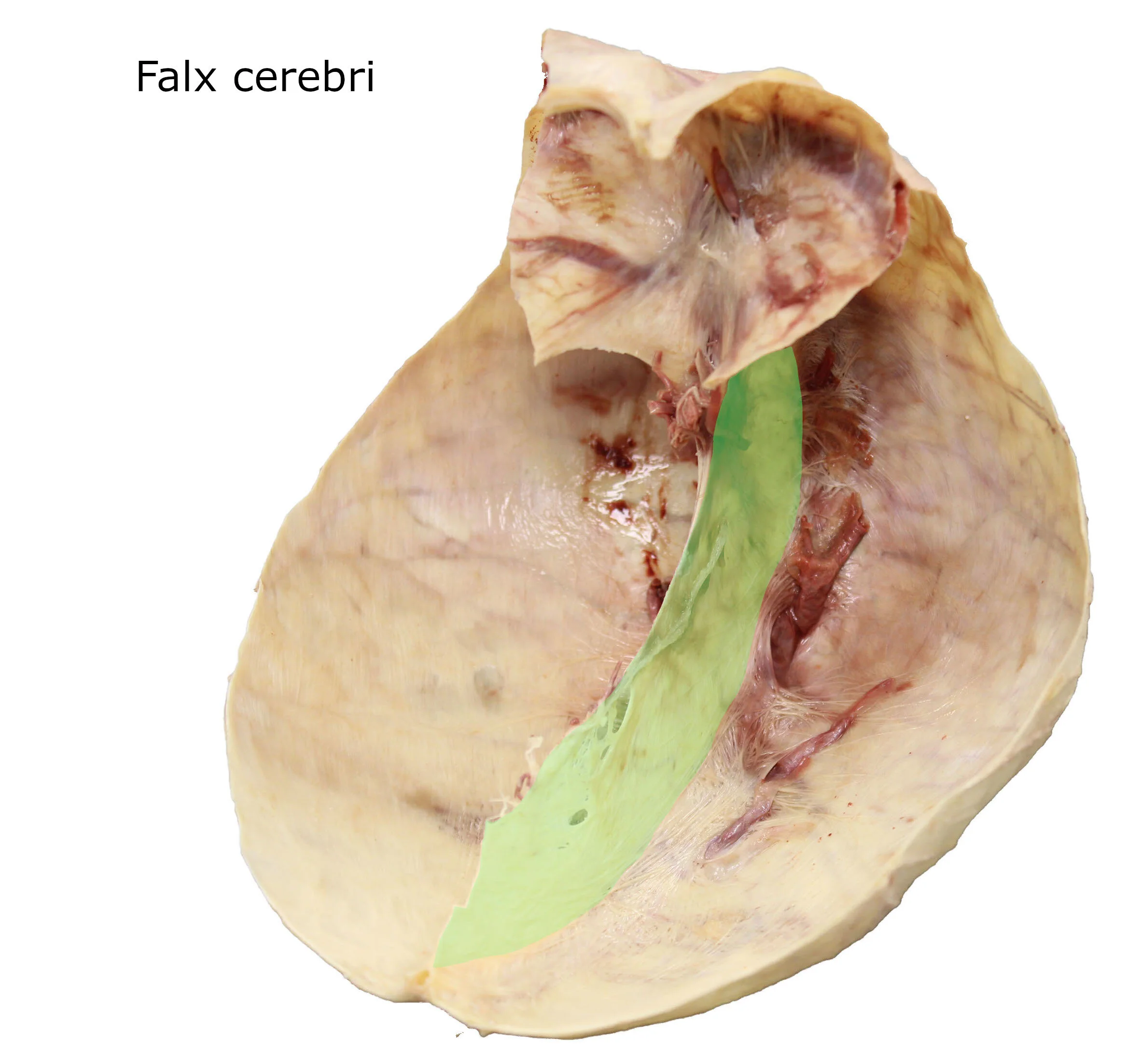 Falxcerebri_editedimage_labelled.JPG