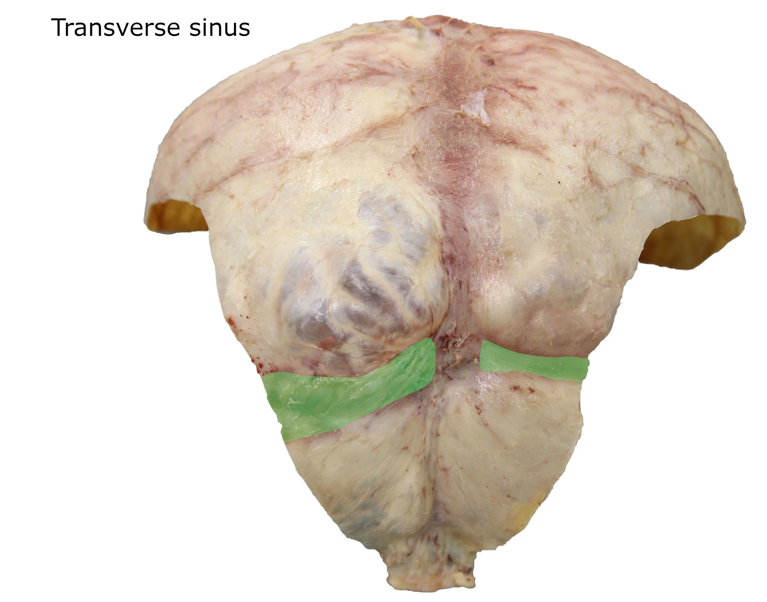 Transversesinus_editedimage_labelled.JPG