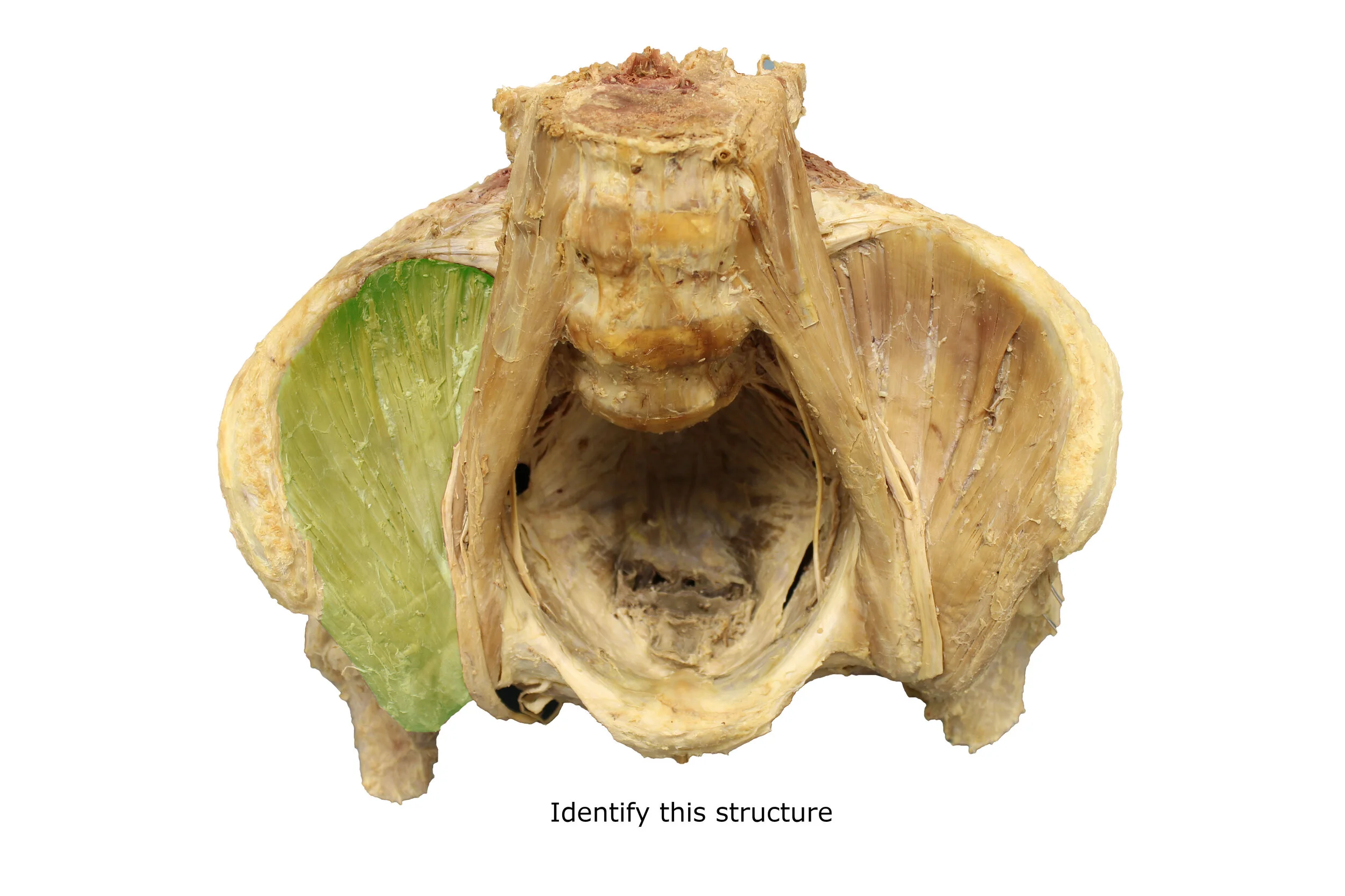 Iliacus_muscle_editedimage_identify.jpg