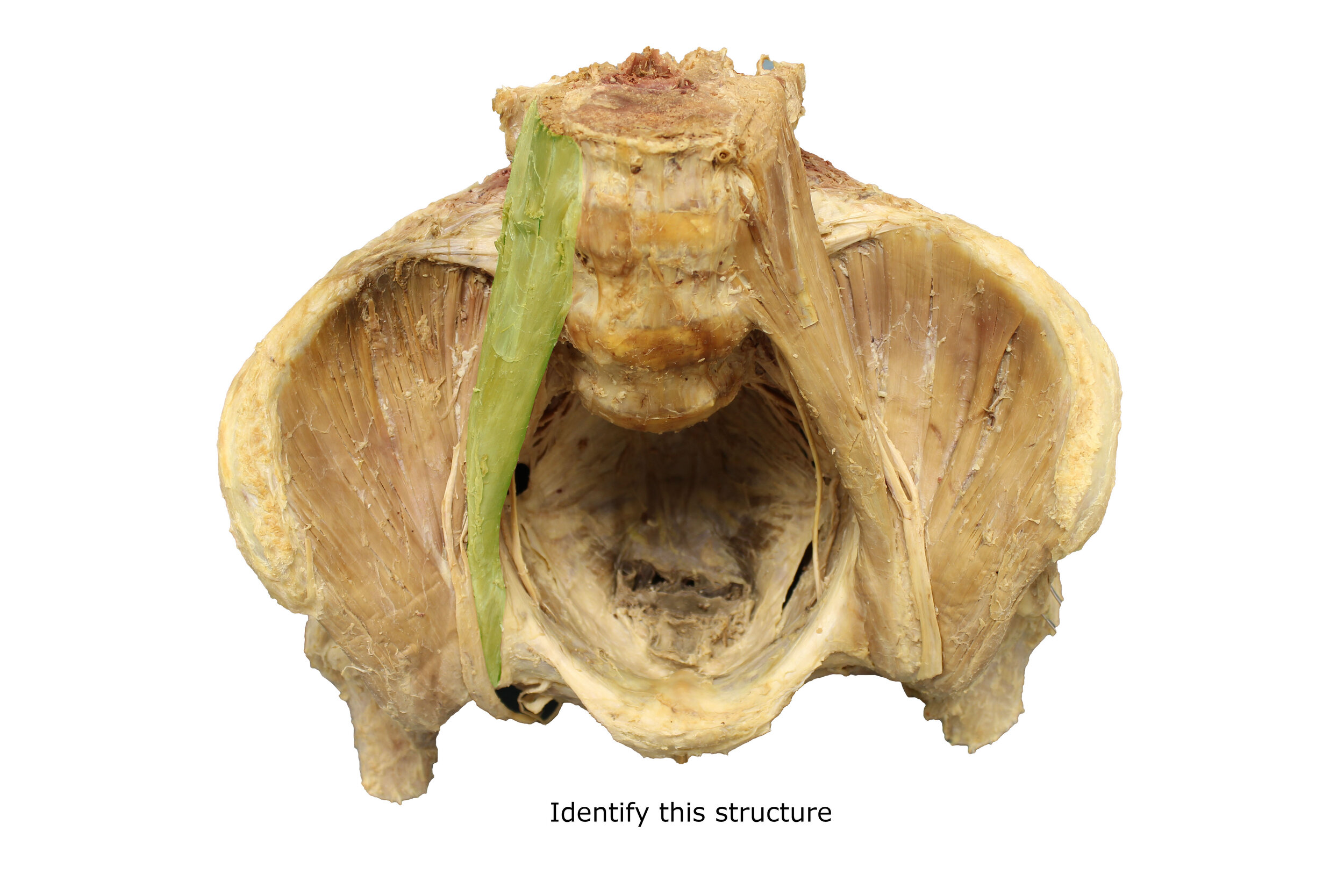 Psoas_major_muscle_editedimage_identify.jpg