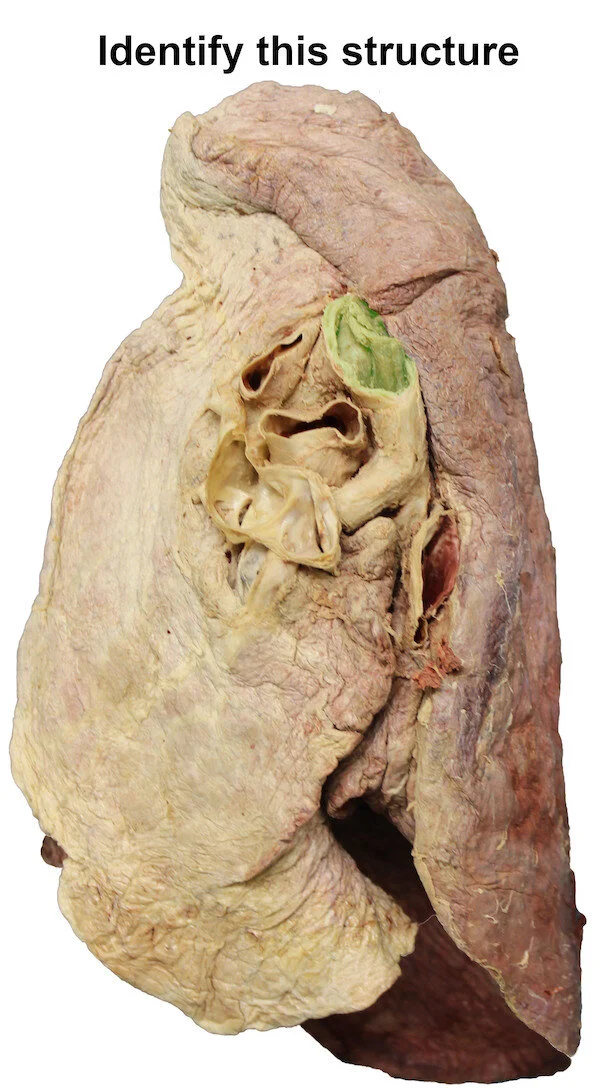 mainbronchus_editedimage_identify.jpg