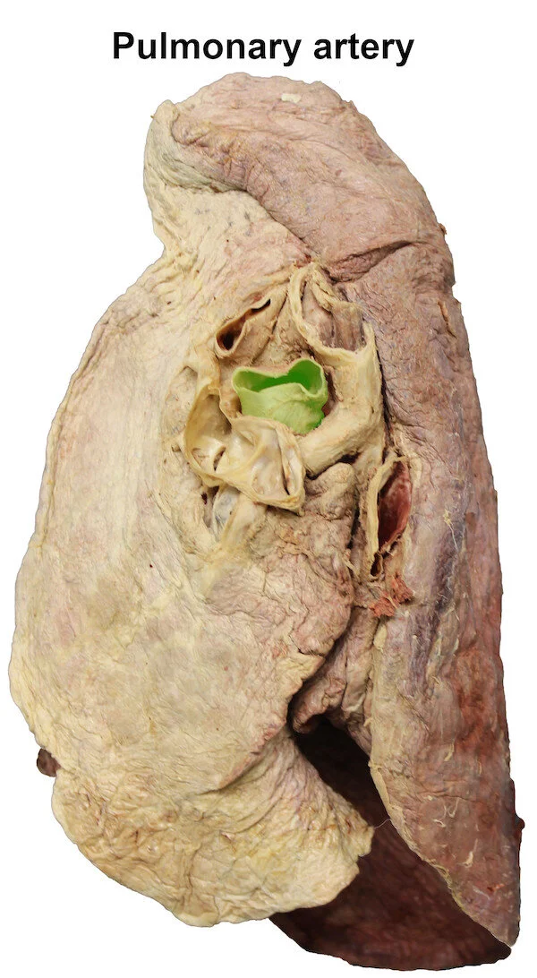 pulmonaryartery_editedimage_labelled.jpg