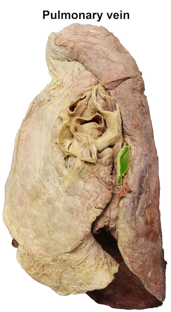 pulmonaryvein2_editedimage_labelled.jpg