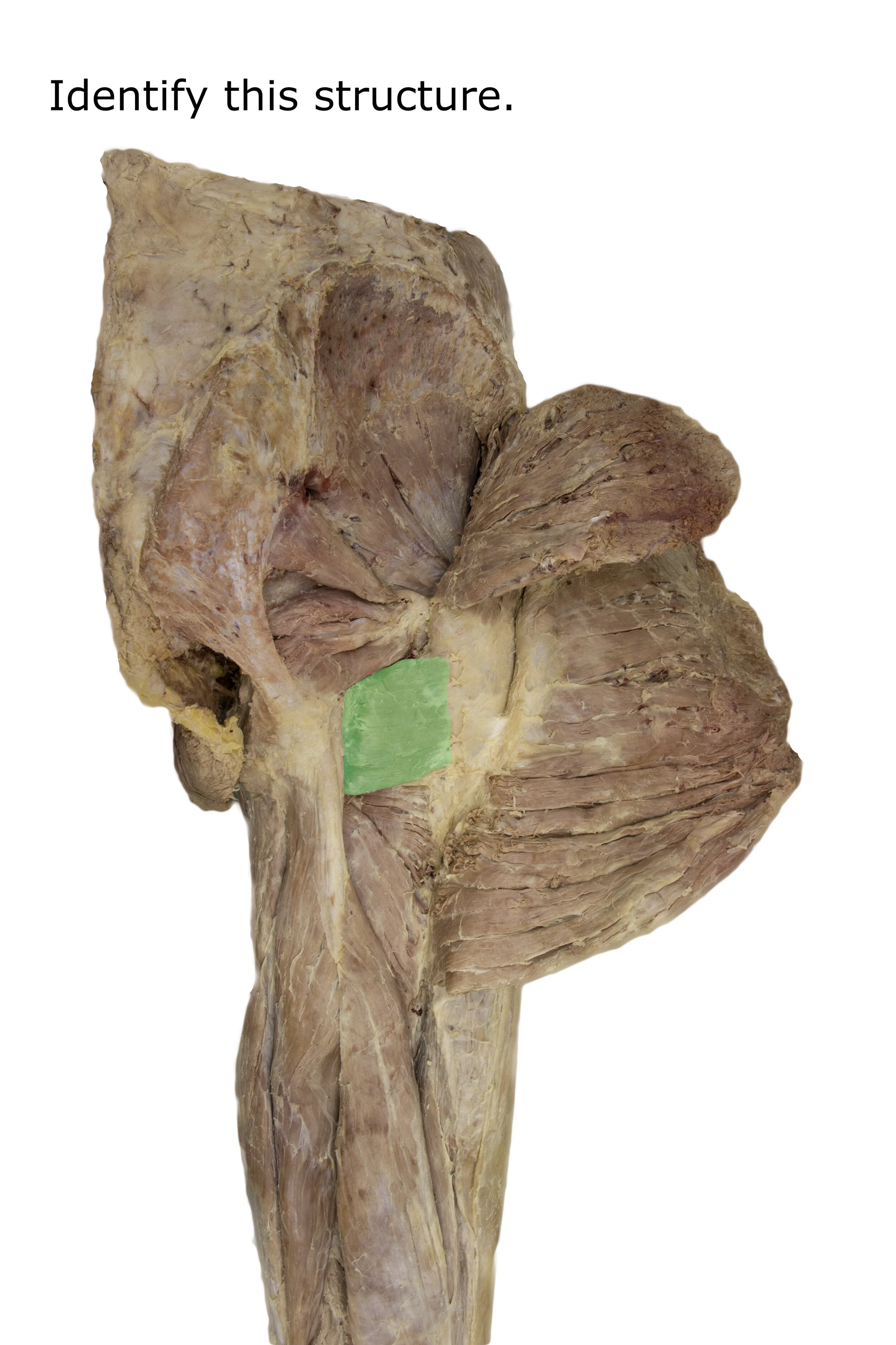Quadratusfemoris_editedimage_identify.jpg