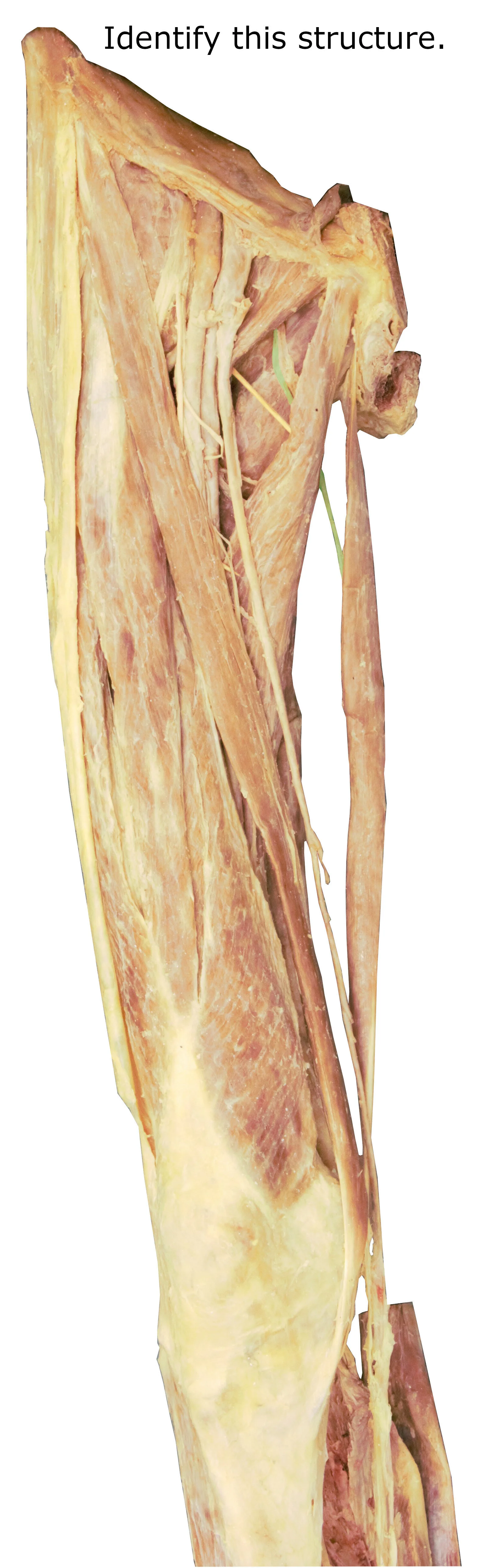 Obturatornerve_editedimage_identify.jpg