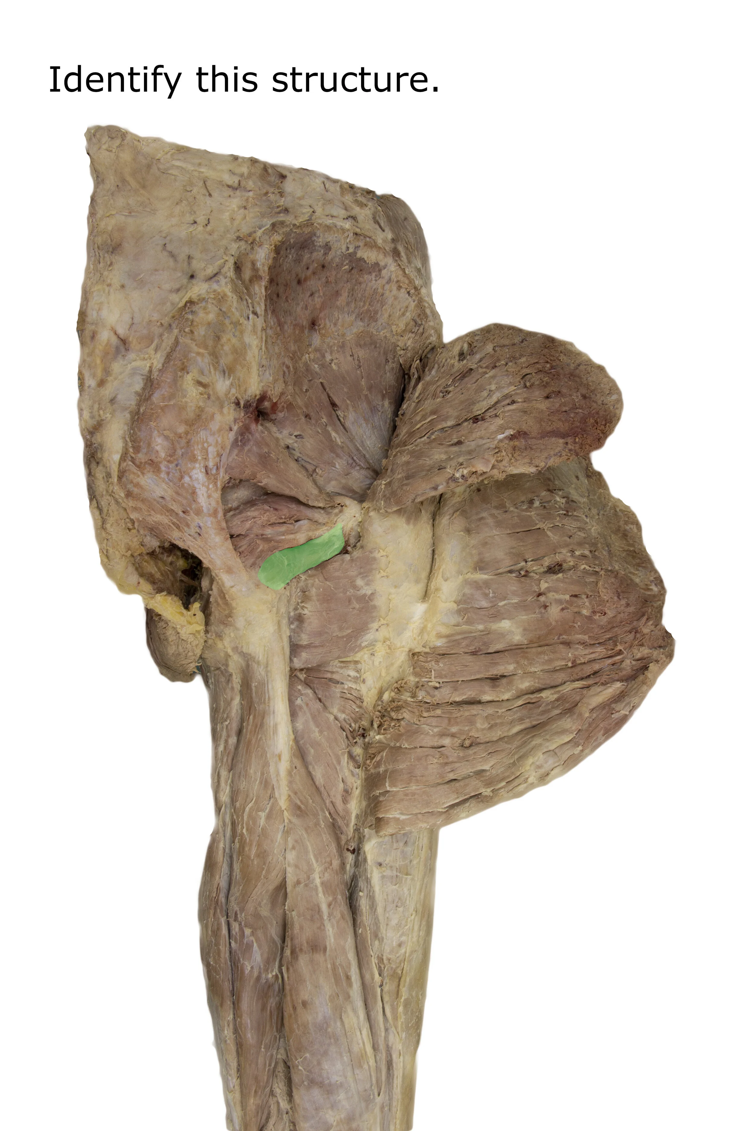 Inferiorgemellus_editedimage_identify.jpg