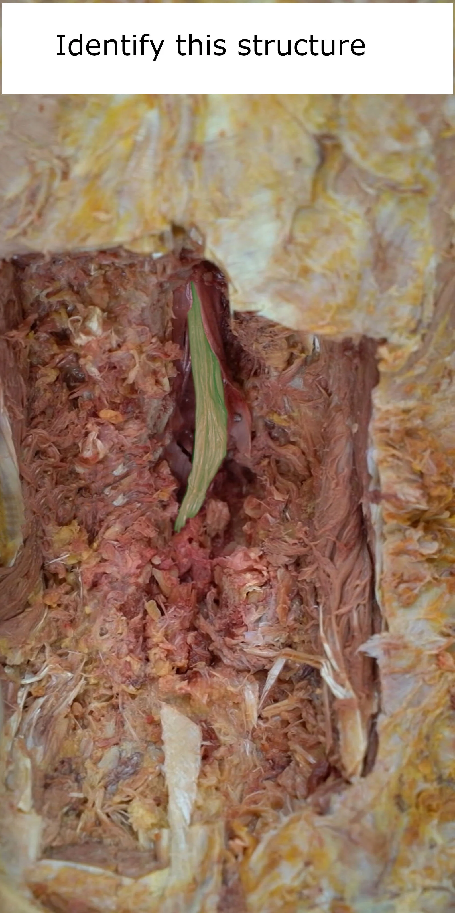 Cauda equina_editedimage_identify.JPG