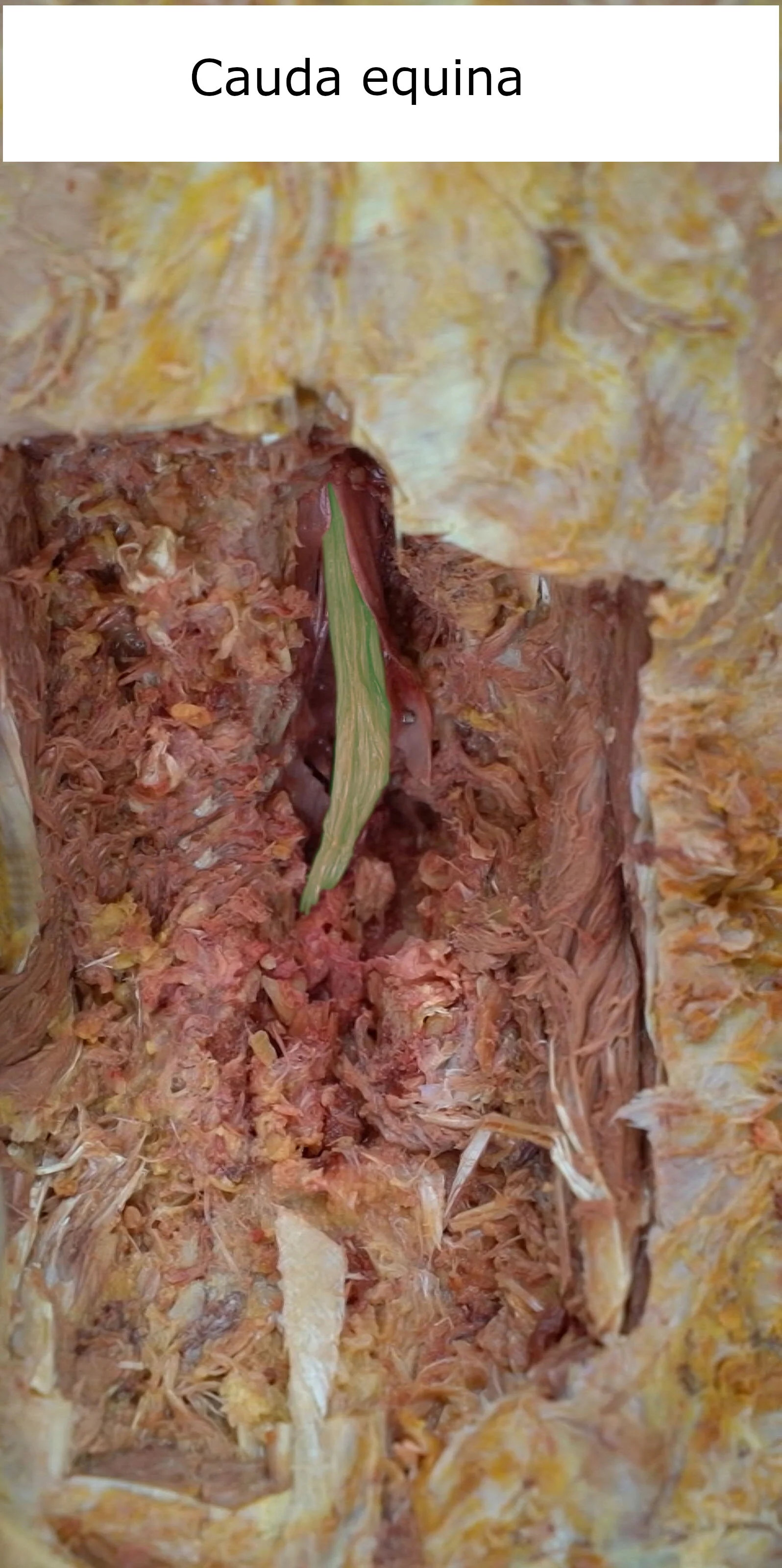 Cauda equina_editedimage_labelled.JPG