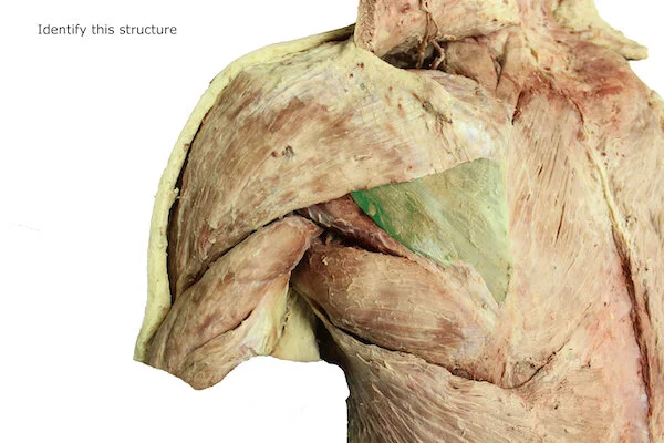 Infraspinatus muscle_editedimage_identify.JPG