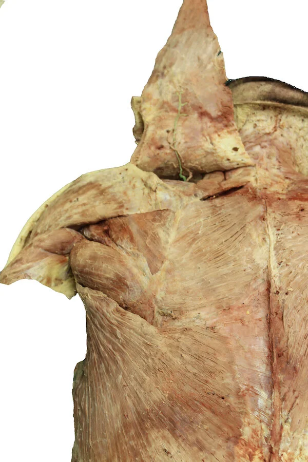 Spinal accessory nerve_editedimage.JPG