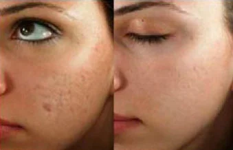 micro-needling-1.jpg