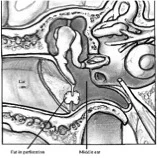Figure 2.1: Fat myringoplasty