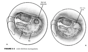 Figure 2.2: Alloderm myringoplasty