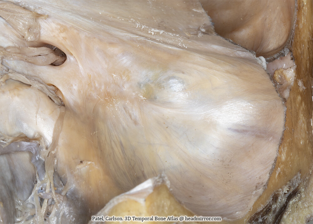11-5 Intracranial view of ELS and porus - No annotations.jpg