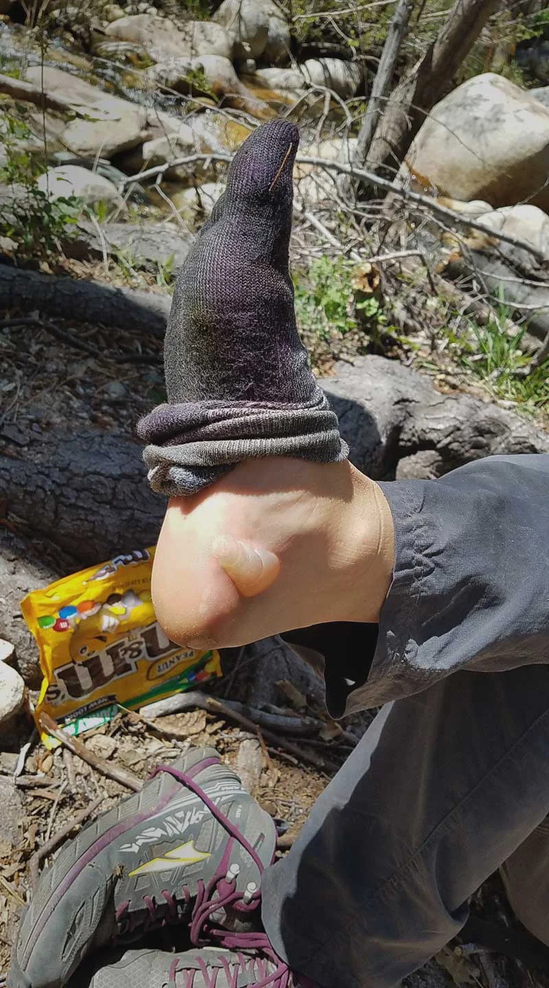 A PCT hiker with a monster blister. Try never to let it get this bad! Photo by: Malin Klingsell