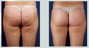cavitation & Radio frequency -lipo laser