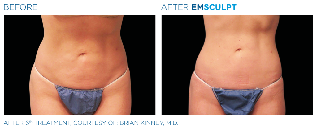 AFTER 6 EMSCULPT TREATMENTS