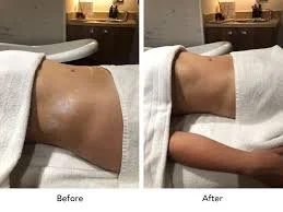 lymphatic massage 2