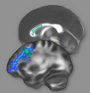The brain’s white matter, shown above, contains the connections between neurons. The white matter regions highlighted in green or blue showed changes after intense preparation for the LSAT, suggesting improved interconnections among reasoning areas of the brain. (Bunge lab image.)
