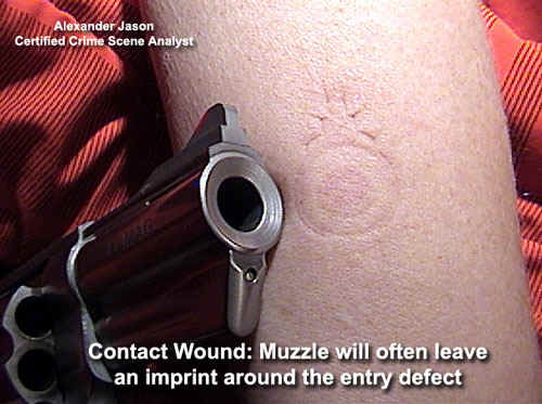 1. The form of the chest wound is consistent with a wound produced by the firing of a firearm while the muzzle (barrel) was in hard contact with the chest. The entry defect (hole) is surrounded by what appears to be a larger area of abraded skin. This abrasion is caused by the rubbing of the skin against the hard steel of the gun muzzle.