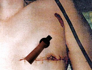2. The abraded muzzle imprint surrounding the entry defect appears to reflect the front sight blade at the approximate "2 o'clock" position indicating that the pistol was rotated as indicated in the images shown below. This orientation