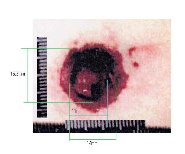3. The dimensions shown appear to be consistent with a 2", .38 cal Rossi revolver. The actual bullet hole will usually be approximately the same diameter as the bullet. The stretching of the tissue can make the hole larger than the bullet. I do not