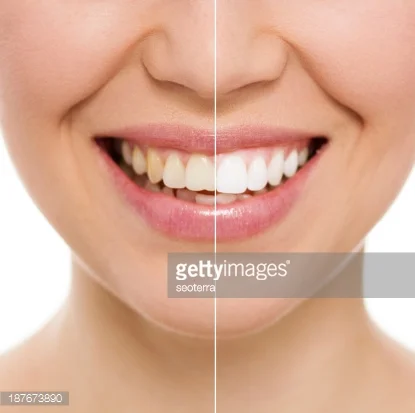 What to Know about DIY Teeth Whitening