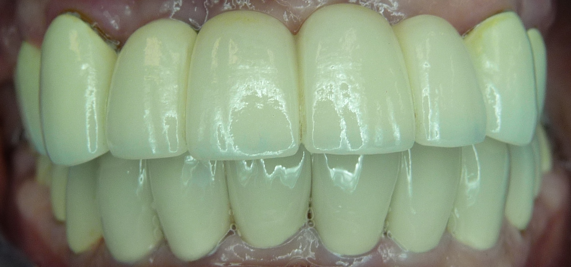  Upper Implant Supported Porcelain Bridge  Lower SIngle Porcelain Crowns 