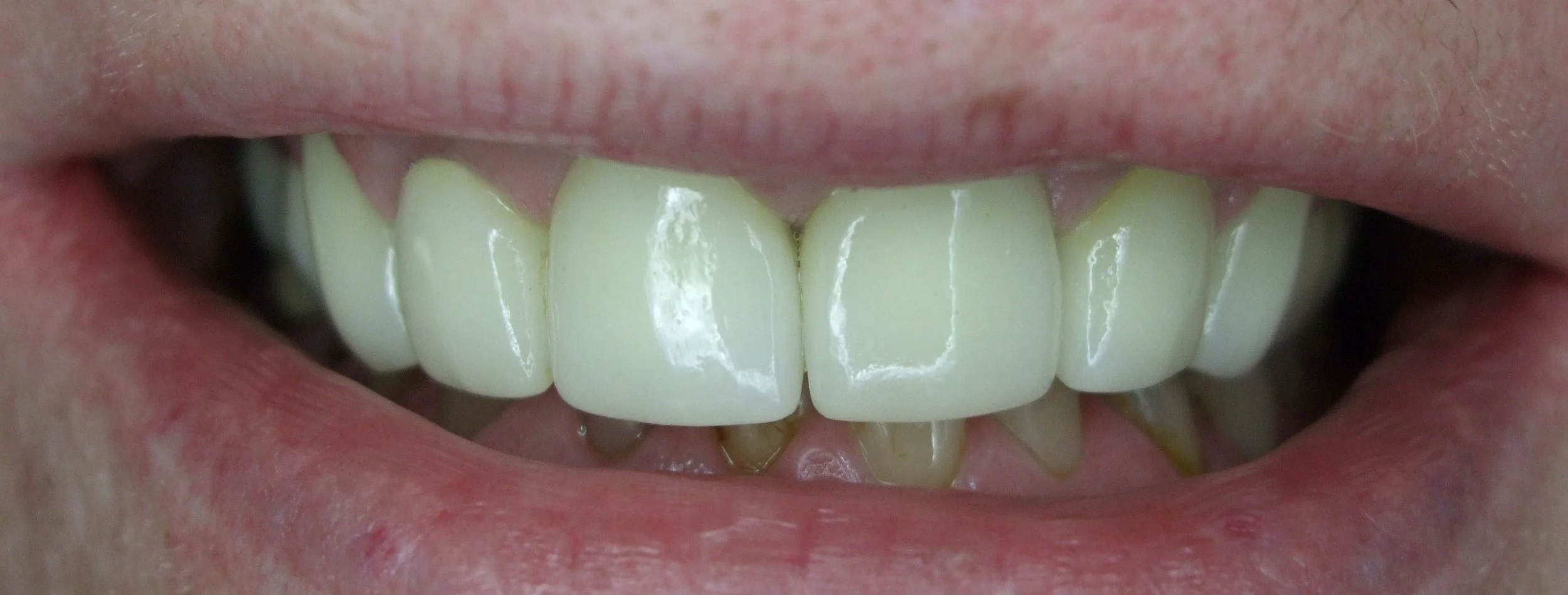 greenfield veneers.jpg
