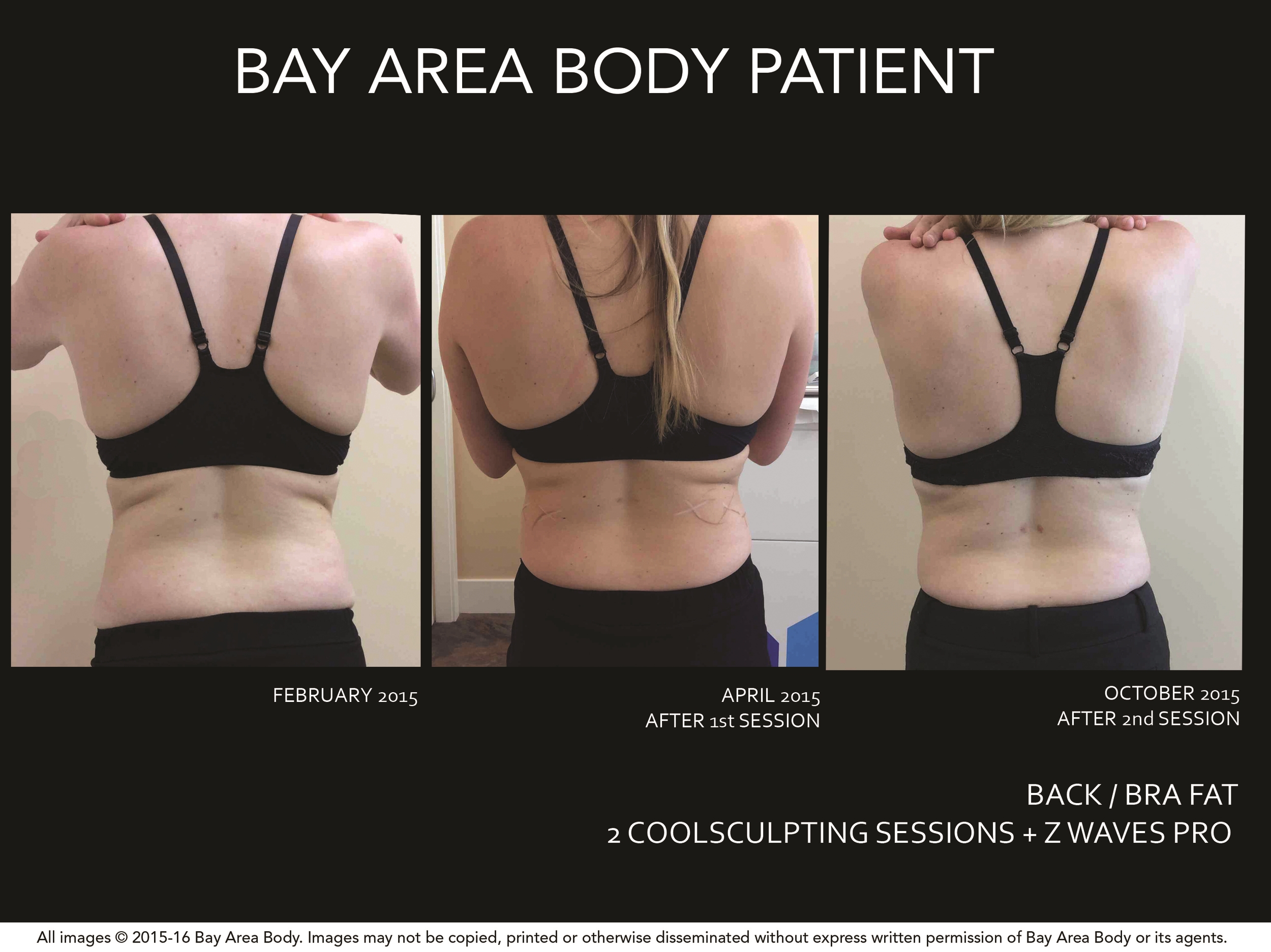 CoolSculpting — Bay Area Body