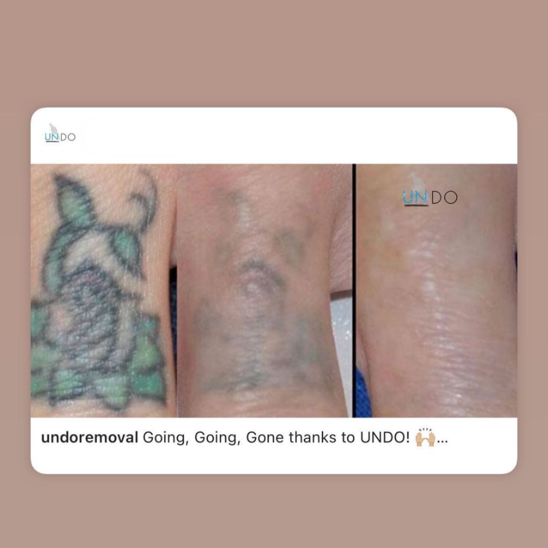 UNDO Tattoo Removal 14.png