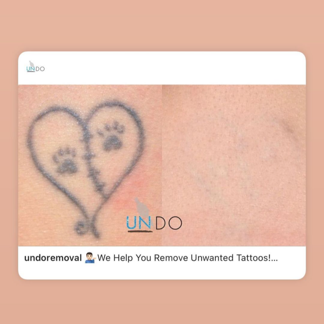 UNDO Tattoo Removal 13.png