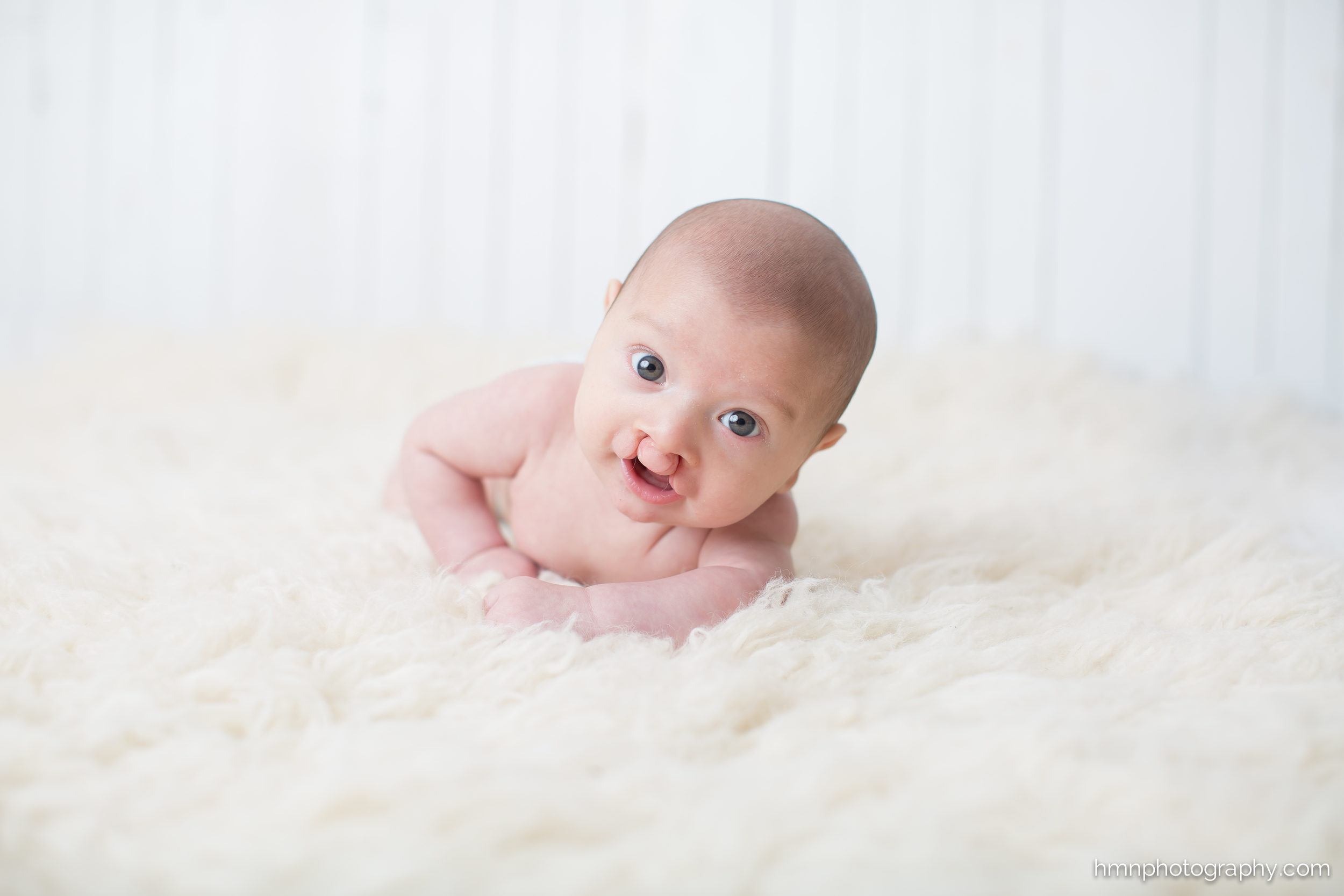 Cleft Lip and Palate