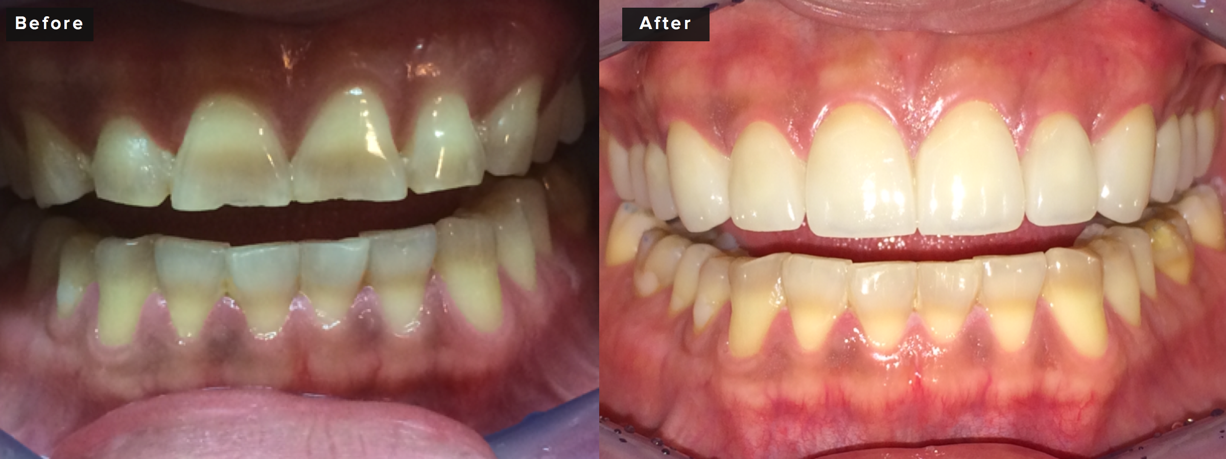 This patient also had twelve upper crowns prepared in order to address severe tetracycline staining, heavy wear, and poor gum contours. We were able to completely mask all staining, rebuild his bite and provide added vertical dimension to replace his worn enamel, and also properly contour his gingival tissues with a diode laser to provide more symmetrical shaping that is more masculine in nature than the initial tapered presentation. This procedure took about four hours of preparation time and about an hour and a half of insertion time. Two visits not including the work-up and consultation visits. Two to three weeks between preparation and insertion.