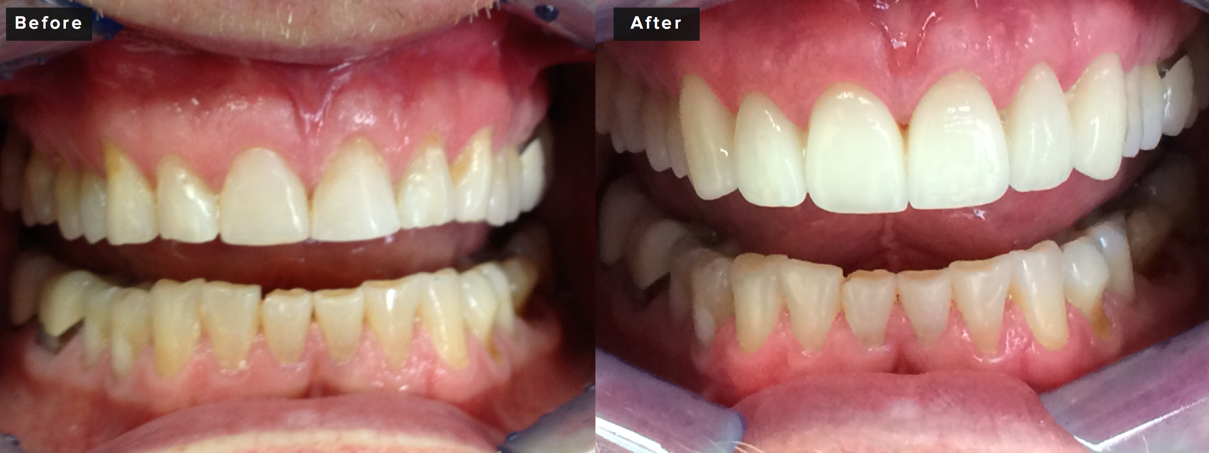 This case involved six front upper teeth, also done in all porcelain. The patient concerns were moderate to severe wear due to grinding and we were able to create an improved smile while also providing properly protected occlusion with specific detailed rebuilding of his bite. We achieved better aesthetics by rebuilding the teeth but also by recontouring his tissues slightly to increase the vertical dimension and provide improved symmetry. About two hours of prep time and an hour and a half for insertion. 