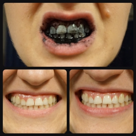  Charcoal Brushing Before & After 